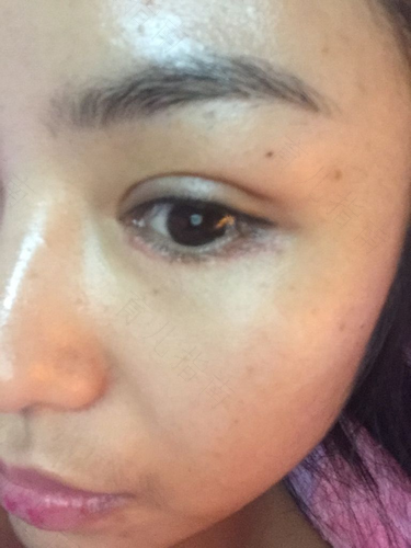 冻疮留疤怎么办