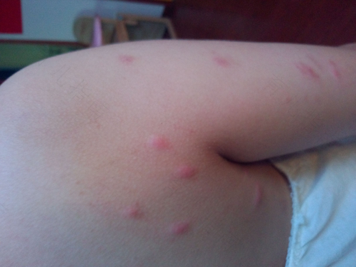 过敏起了红疙瘩怎么办 过敏起了红疙瘩怎么办