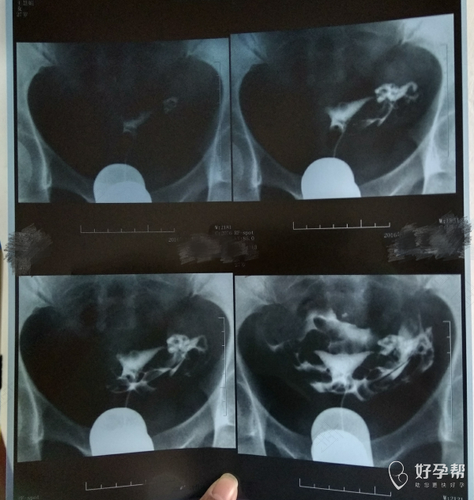 什么时候需要做输卵管造影检查 什么时候需要做输卵管造影检查