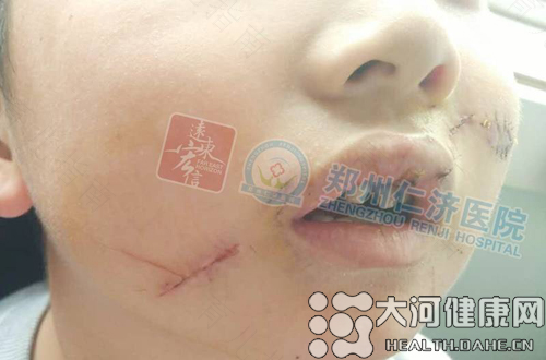 伤口愈合但是留伤疤了怎么办?