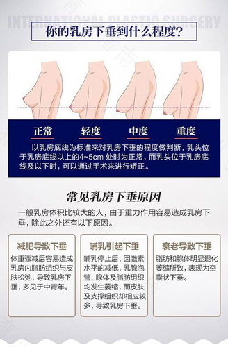 乳房很软下垂怎么办 乳房很软下垂怎么办
