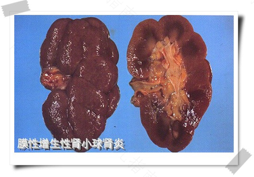 肾炎一般都是怎么引起的 肾炎一般都是怎么引起的
