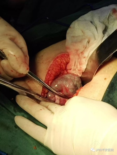 输卵管积水一定要做手术吗 输卵管积水一定要做手术吗