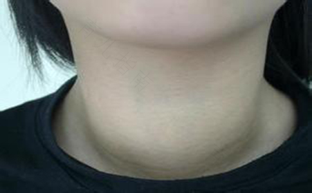 甲亢病人会胖吗? 甲亢病人会胖吗?