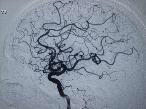 脑动脉栓塞最可能出现的症状 脑动脉栓塞最可能出现的症状