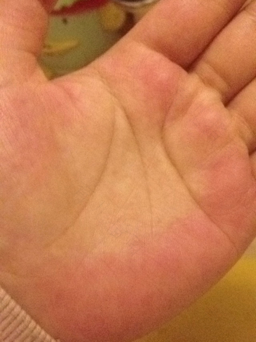 青年手心发热发烫是怎么回事 青年手心发热发烫是怎么回事