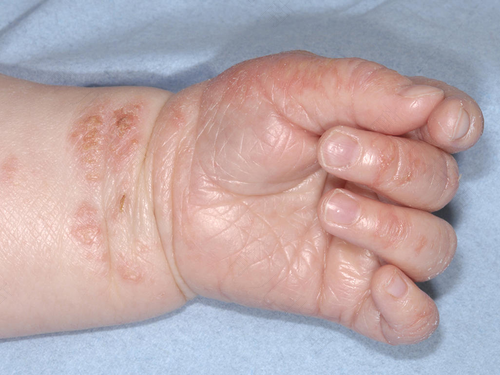 湿疹会呼吸不畅吗 湿疹会呼吸不畅吗