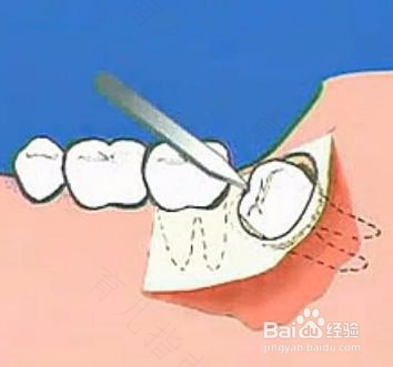 拔牙后多久可以漱口刷牙 拔牙后多久可以漱口刷牙
