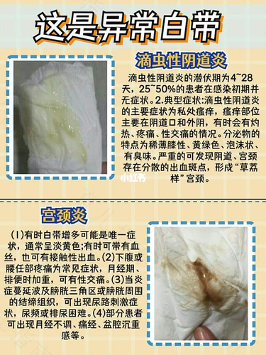 为什么会白带异常现象 为什么会白带异常现象