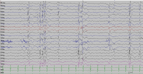 广泛性棘慢波严重吗 广泛性棘慢波严重吗