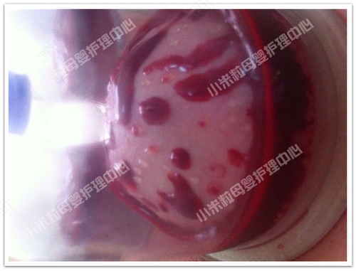 乳腺炎溃烂流脓怎么办 乳腺炎溃烂流脓怎么办