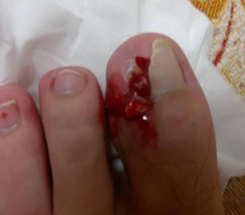 甲沟炎严重了怎么办? 甲沟炎严重了怎么办?