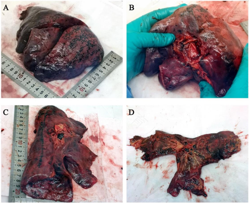 右肺炎症严重吗? 右肺炎症严重吗?
