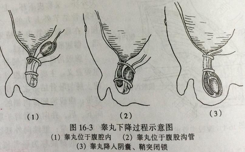 小儿疝气形成原因 小儿疝气形成原因