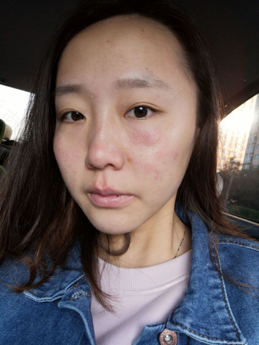 面部皮炎脱皮会持续多久 面部皮炎脱皮会持续多久