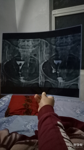 输卵管伞端粘连是怎么造成的