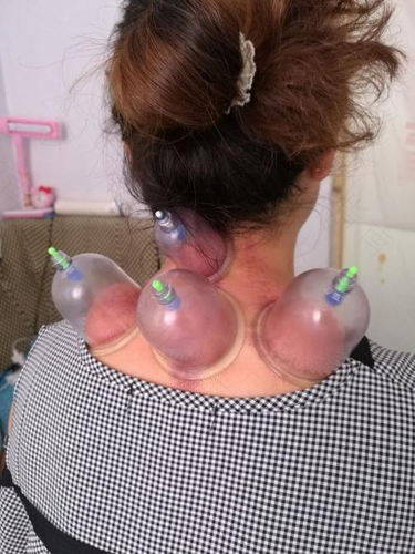 颈椎疼拔罐拔哪个部位图片 颈椎疼拔罐拔哪个部位图片