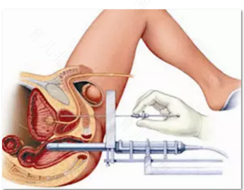 前列腺穿刺后尿血怎么办 前列腺穿刺后尿血怎么办