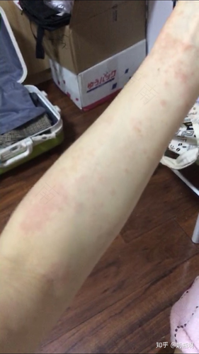 打完疫苗出疹子怎么办