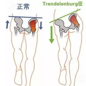 锻炼后肌肉无力是怎么回事