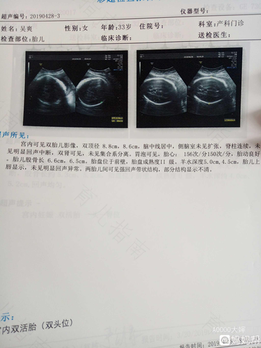 宫颈后方有包块是什么