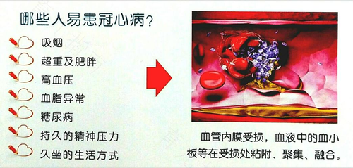冠心病初期能治好吗 冠心病初期能治好吗