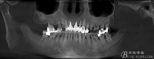 牙周炎可以种牙吗? 牙周炎可以种牙吗?