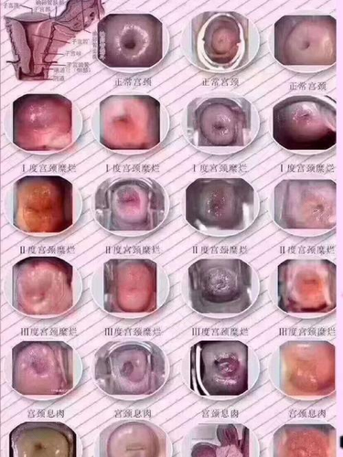 轻微子宫糜烂能自愈吗 轻微子宫糜烂能自愈吗