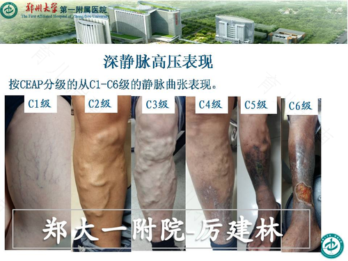 静脉曲张特别严重怎么办 静脉曲张特别严重怎么办