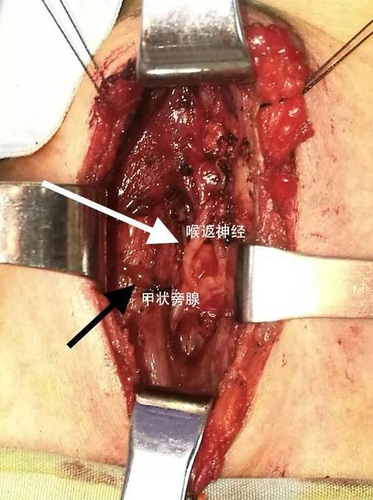 甲状腺穿刺有什么副作用吗 甲状腺穿刺有什么副作用吗