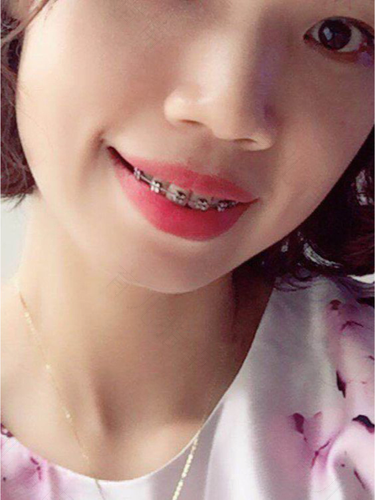 30多岁矫正牙齿好不好 30多岁矫正牙齿好不好