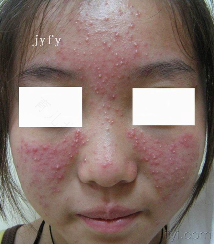 脸部毛囊炎多久才能好 脸部毛囊炎多久才能好