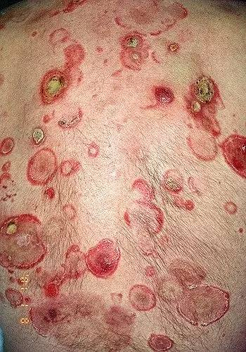 白血病有哪些症状? 白血病有哪些症状?