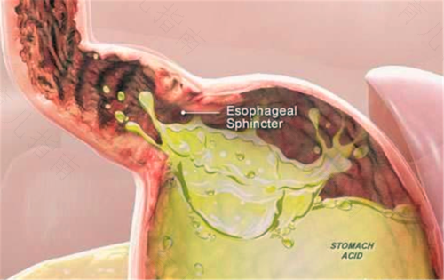 胃酸烧心怎么治疗 胃酸烧心怎么治疗