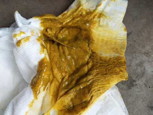 肚子大便酸臭一直发烧