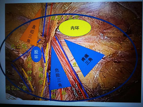 直疝与斜疝的区别图解 直疝与斜疝的区别图解