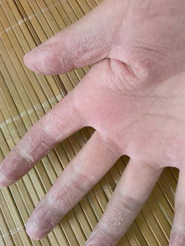 手指脱皮开裂是缺什么元素