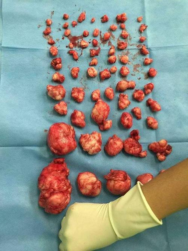 子宫肌瘤2公分严重吗