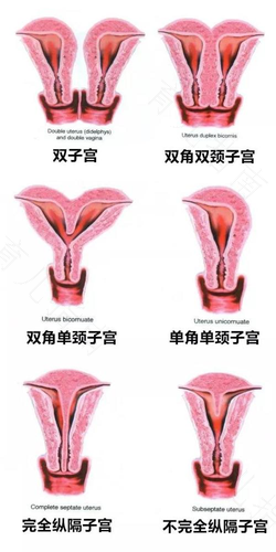 始基子宫和幼稚子宫的区别 始基子宫和幼稚子宫的区别