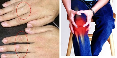 颈椎风湿的症状是什么 颈椎风湿的症状是什么