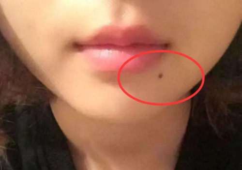 痣越长越大是怎么回事 痣越长越大是怎么回事