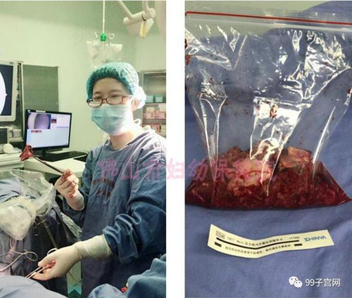 做完宫腔镜手术肚子疼 做完宫腔镜手术肚子疼