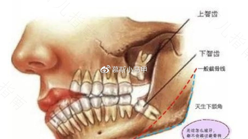 拔智齿脸会变小吗知乎