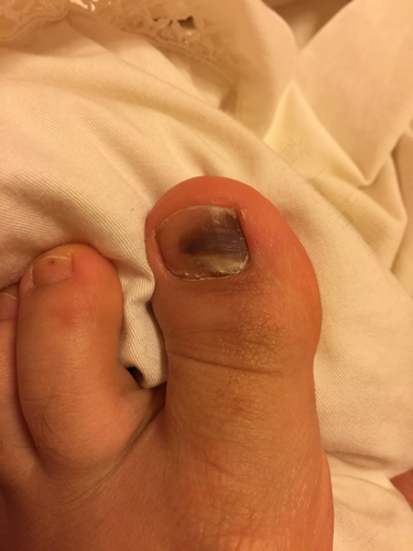 脚趾头突然变紫是怎么回事 脚趾头突然变紫是怎么回事