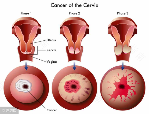 子宫囊肿是什么病严重吗 女性 子宫囊肿是什么病严重吗 女性