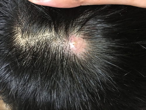 头上反复长脓包怎么办小偏方 头上反复长脓包怎么办小偏方