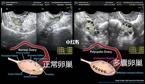 怎么查是否有多囊卵巢综合症 怎么查是否有多囊卵巢综合症