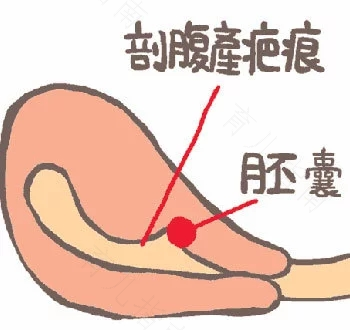 子宫疤痕窒息怎么处理 子宫疤痕窒息怎么处理