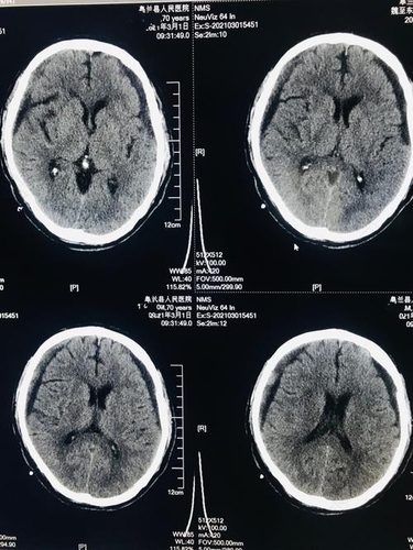 硬脑膜下腔出血 硬脑膜下腔出血