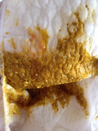 五天没拉屎了怎么办 五天没拉屎了怎么办